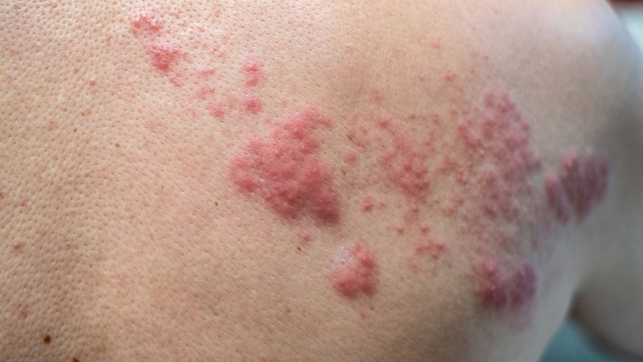 rash on the back